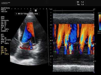 Эхография в кардиологии
