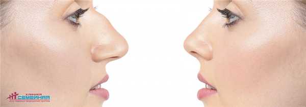 Эстетическая ринопластика