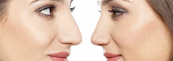 Вторичная ринопластика: когда и кому она грозит