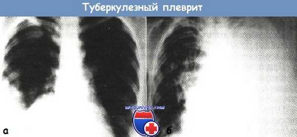 Туберкулезный плеврит