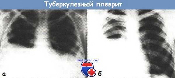 Туберкулезный плеврит