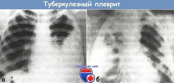 Туберкулезный плеврит