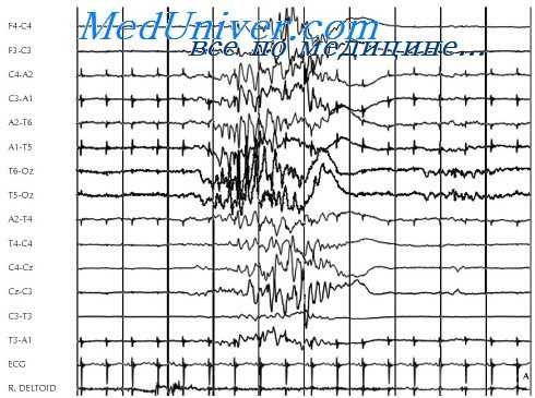 состояние мозга при эпилепсии