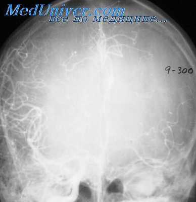 пневмоэнцефалограммы при эпилепсии