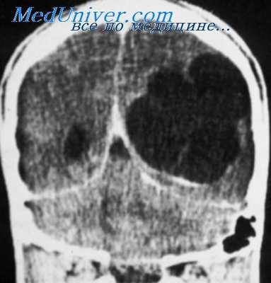 пневмоэнцефалография при эпилепсии