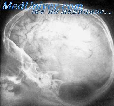 исследование при эпилепсии