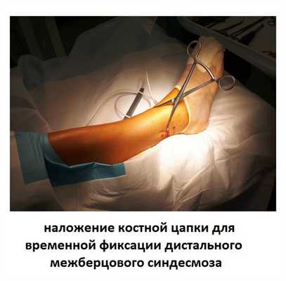 фиксация межберцового синдесмоза цапкой