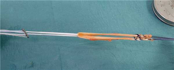 трансплантат из сухожилия нежной мышцы