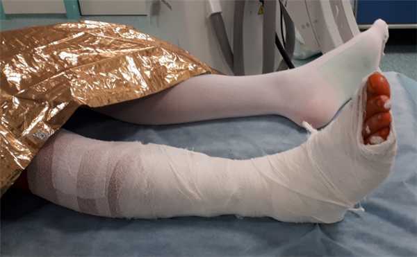 лонгетная гипсовая повязка