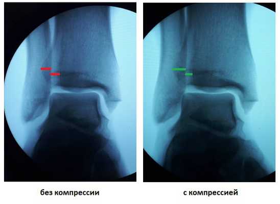 частичный разрыв межберцового синдесмоза 1