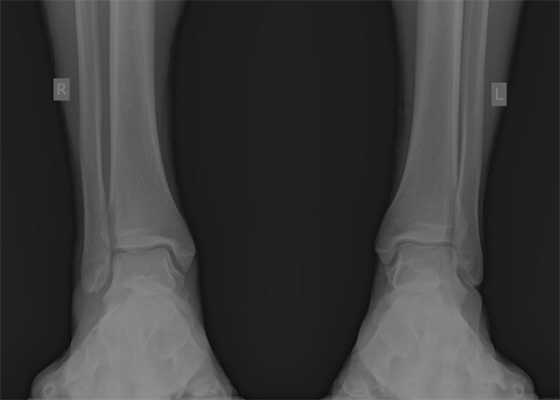 частичный разрыв межберцового синдесмоза