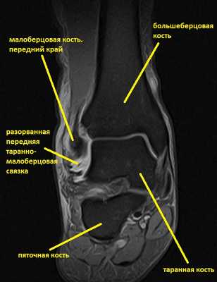 растяжение связок голеностопа мрт