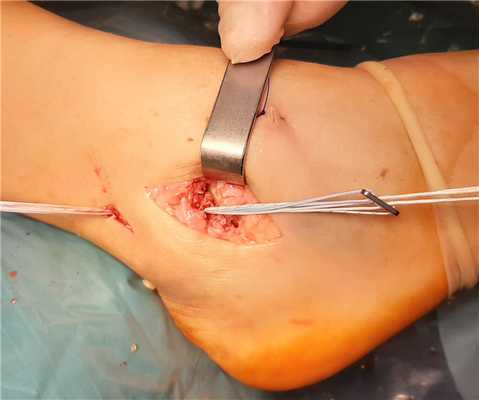 восстановление связок голеностопа при помощи аутосухожилия