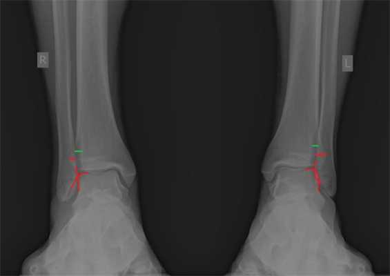 частичный разрыв межберцового синдесмоза рентген 