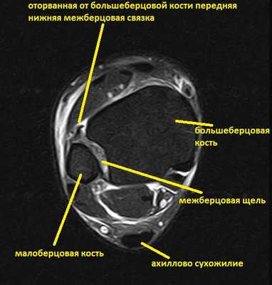 разрыв межберцового синдесмоза мрт