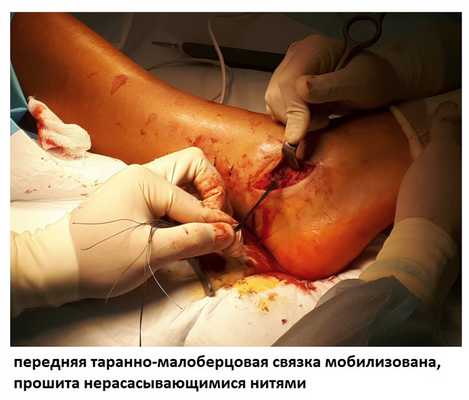 нестабильность голеностопного сустава операция