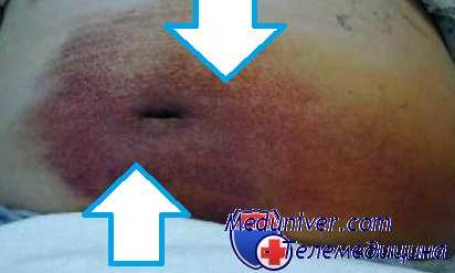 признаки энтерита