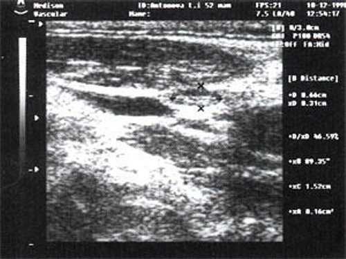 Эхографическое изображение непальпируемого югулярного лимфатического узла без четкой клинической симптоматики воспалительного процесса в области головы и шеи