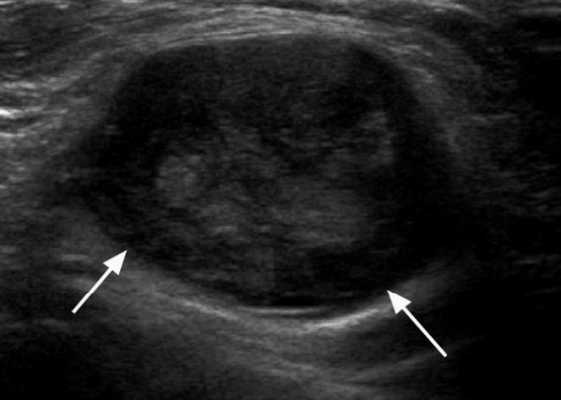 УЗИ лимфатических узлов что показывает