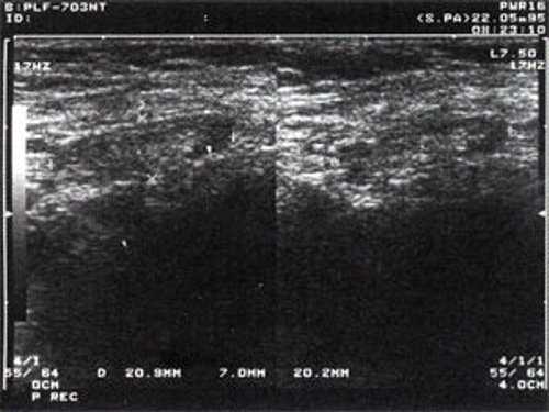 УЗ-томограмма увеличенного реактивно измененного лимфатического узла после проведения противовоспалительного лечения