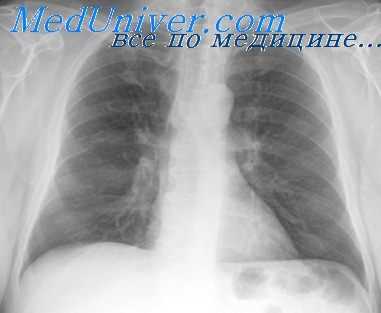 торакопластика