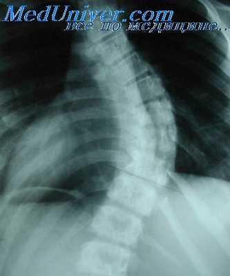 торакопластика