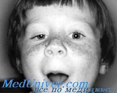 Синдром Маркуса Ганна