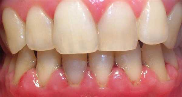 Воспаление десен