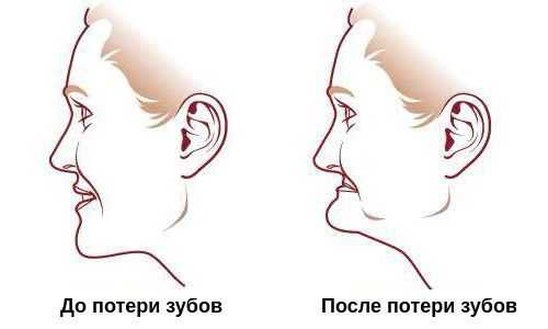 Пропорции лица до потери зубов и после