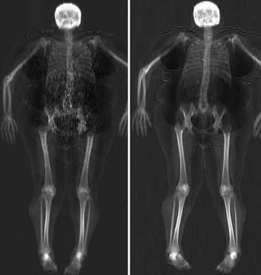 DEXA-сканирование