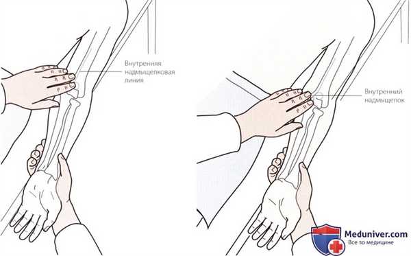 Пальпация локтевого сустава с медиальной стороны