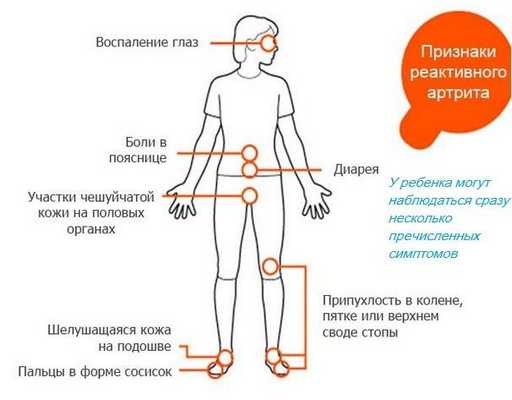 Признаки реактивного артрита