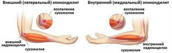 Эпикондилит локтевого сустава