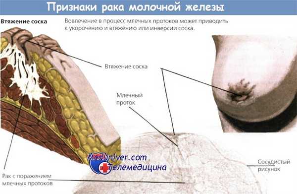 Признаки рака молочной железы