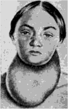 Больная с узловым зобом V степени