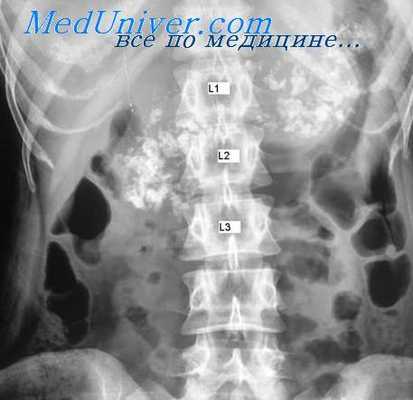 рентгенография поджелудочной железы