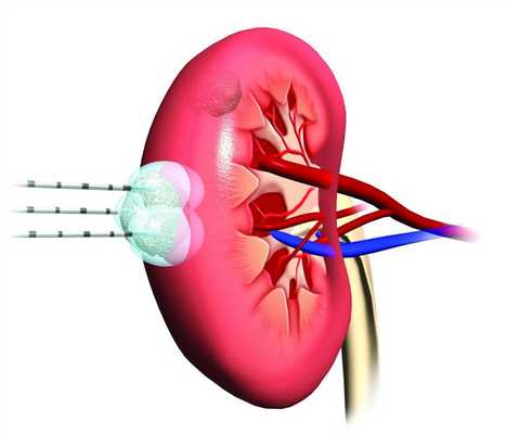Ангиомиолипома почки