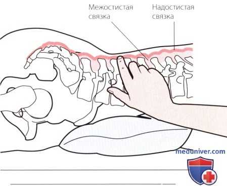 Пальпация костей пояснично-крестцового отдела позвоночника сзади