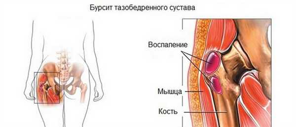 Бурсит тазобедренного сустава