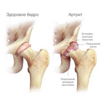 Артрит тазобедренного сустава