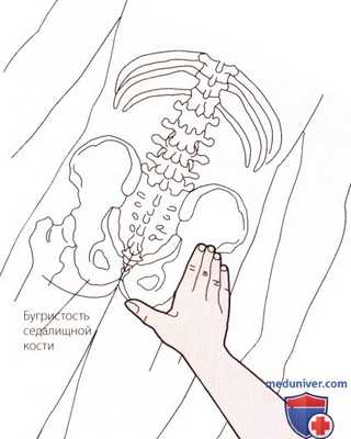 Пальпация тазобедренного сустава сзади лежа на животе