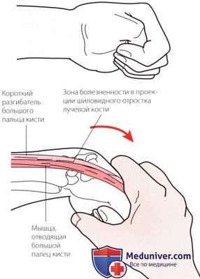 Пальпация запястья и кисти сзади (тыла)