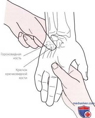 Пальпация запястья и кисти с медиальной (локтевой) стороны