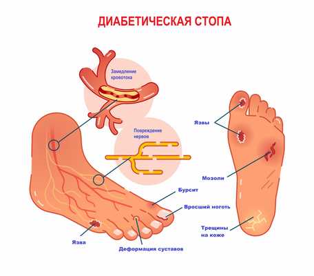 Диабетическая стопа.jpg