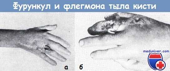 Фурункул и флегмона тыла кисти