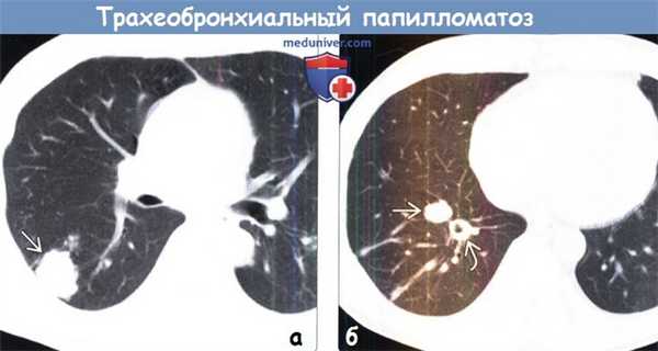 Трахеобронхиальный папилломатоз на КТ