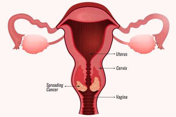 Рак шейки матки