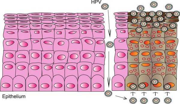 Проникновение ВПЧ в организм через микроповреждение кожи