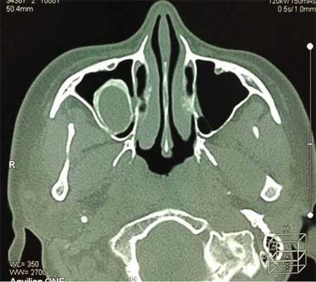 Киста в носовой пазухе