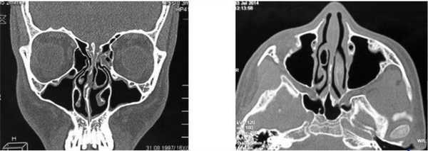 КТ околоносовых пазух ребенка с врожденной изолированной расщелиной неба во фронтальной и аксиальной проекциях 